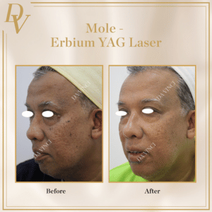 Skin Tag and Mole Removal Before and After Photos