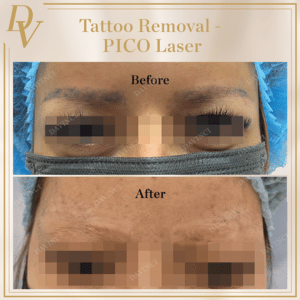 PICO Laser