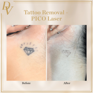 PICO Laser