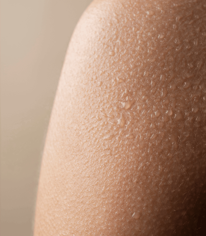 excessive sweating treatment clinic