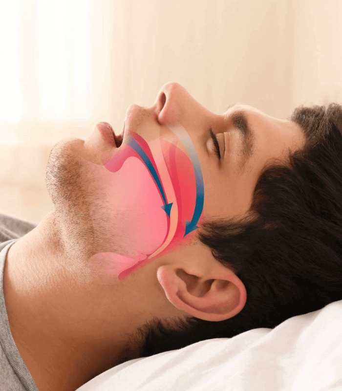 What Cause Snoring