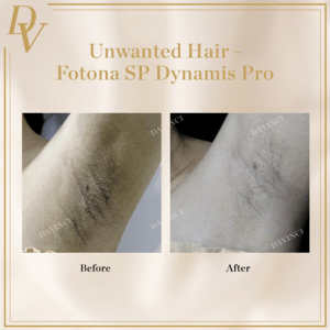 laser hair removal