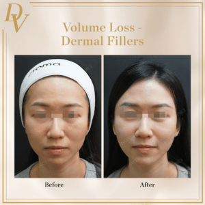 Volume Loss Treatment Before & After