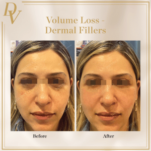 Volume Loss Treatment in KL Before & After