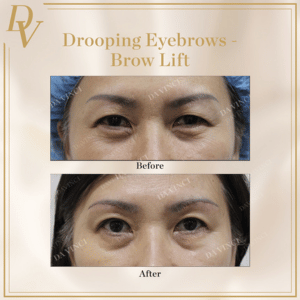 Dermal Filler Brow Lift Before and After