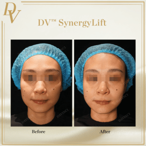 DV Synergy Lift I Da Vinci Clinic