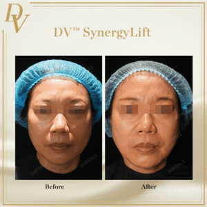 DV Synergy Lift I Da Vinci Clinic