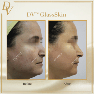 DV™ GlassSkin
