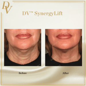 DV Synergy Lift I Da Vinci Clinic