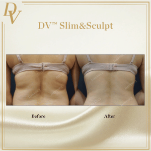 Body Contouring Before & After Photos