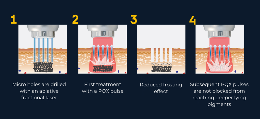 Fotona Laser Treatment in KL