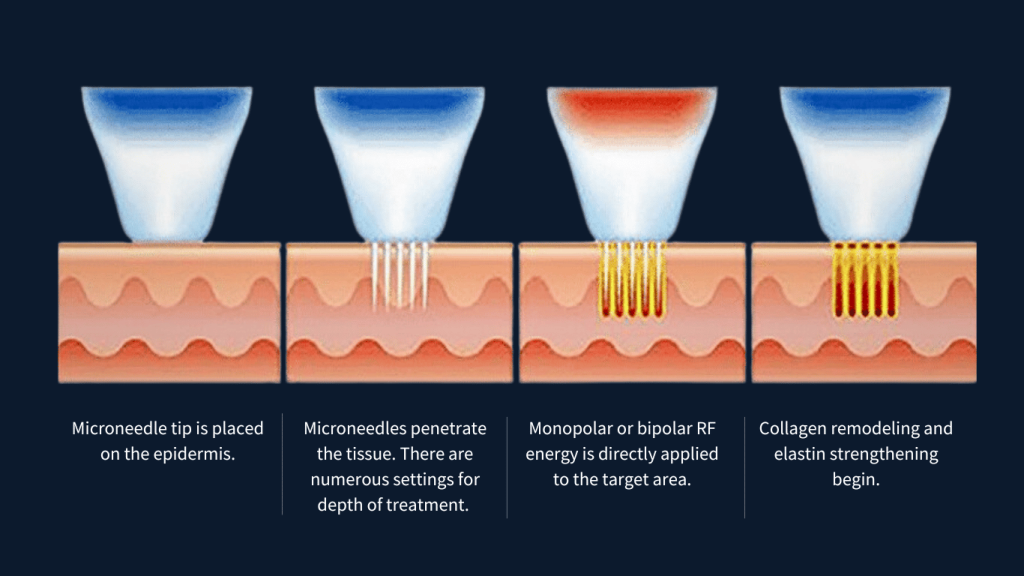 Potenza Treatment in KL