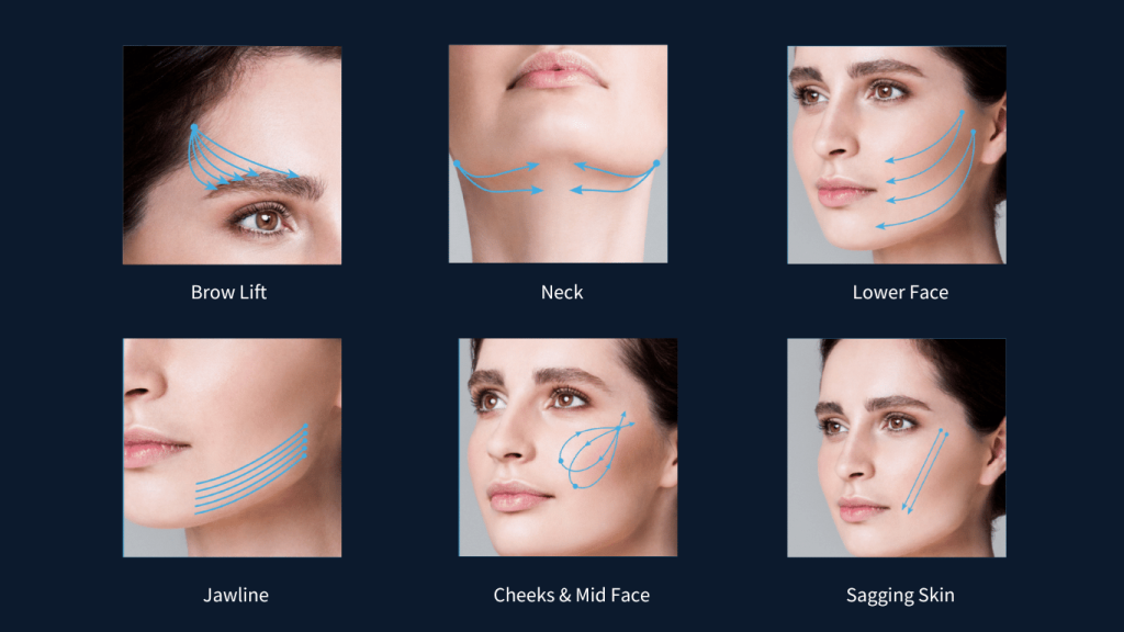 Treatment Areas of Aptos Thread Lift