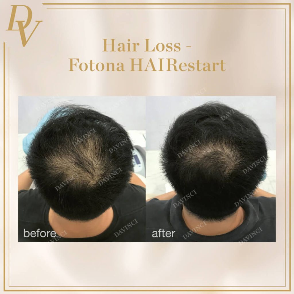 Hair Loss I Da Vinci Clinic