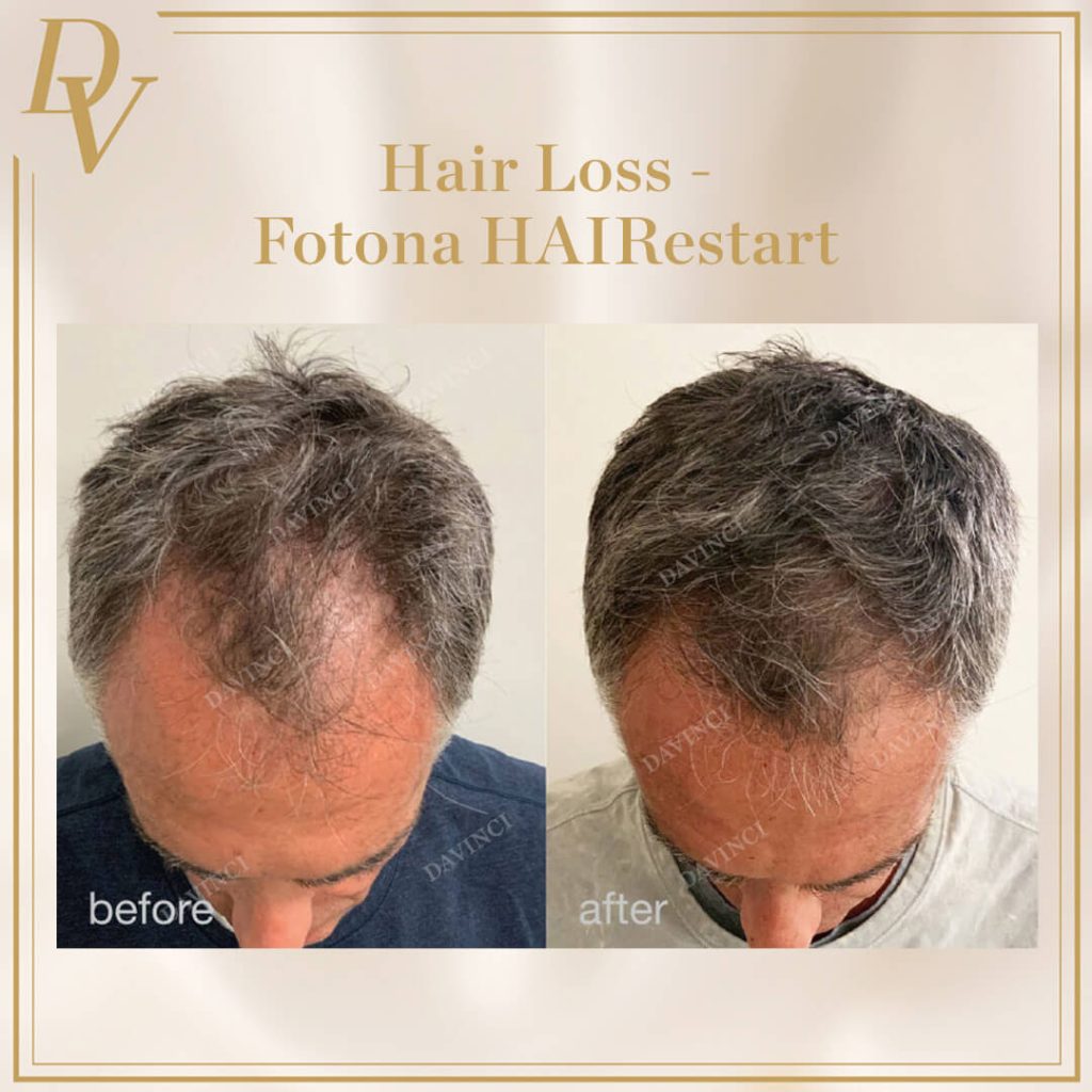 Hair Loss I Da Vinci Clinic