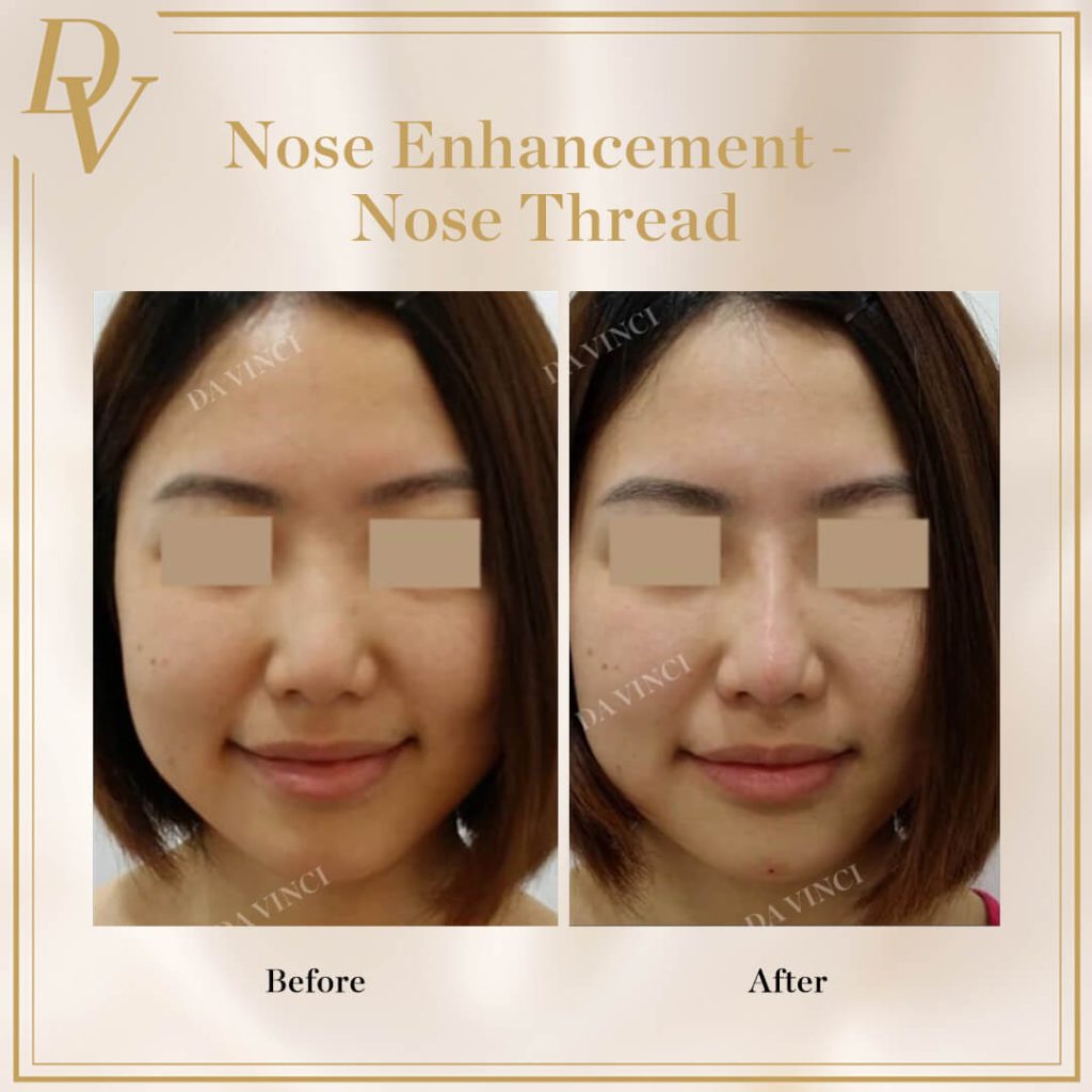 Aptos Thread Lift I Da Vinci Clinic