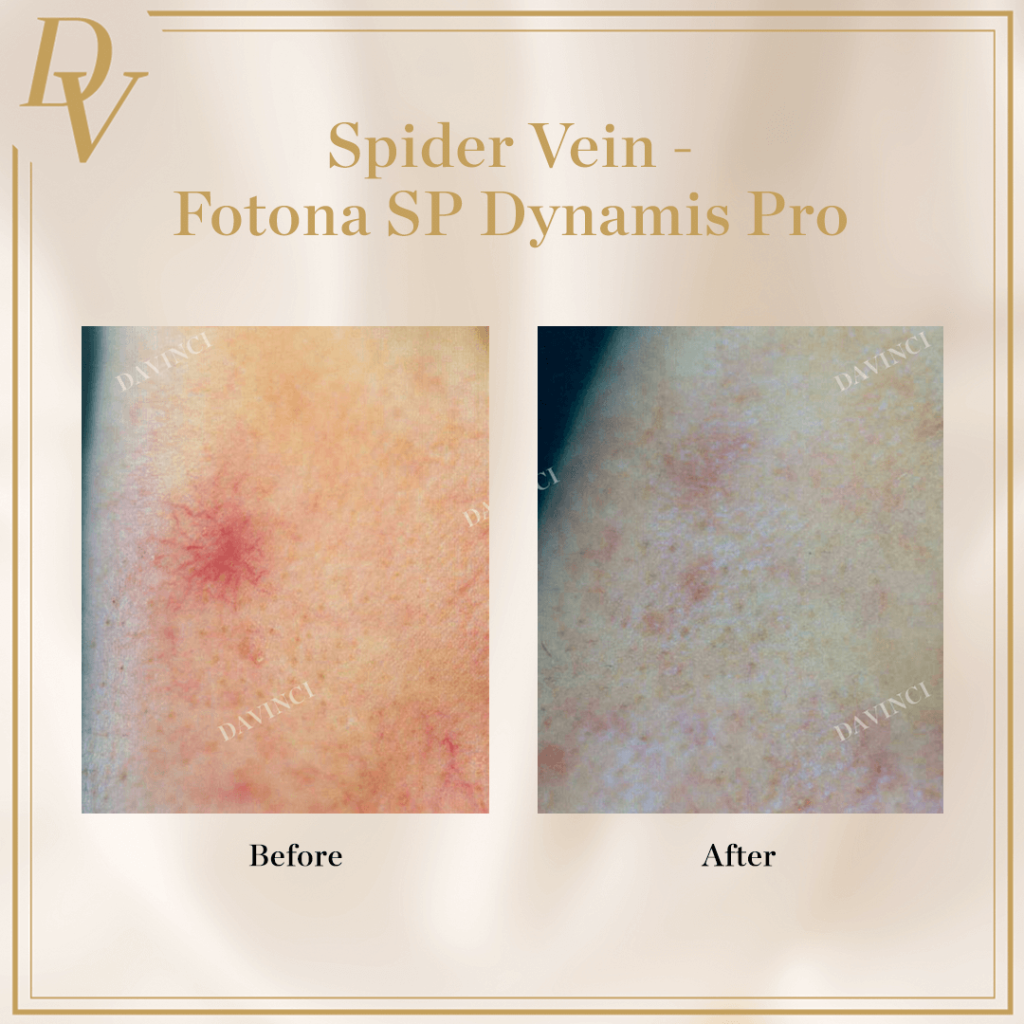 Spider Vein Before and After Da Vinci Clinic