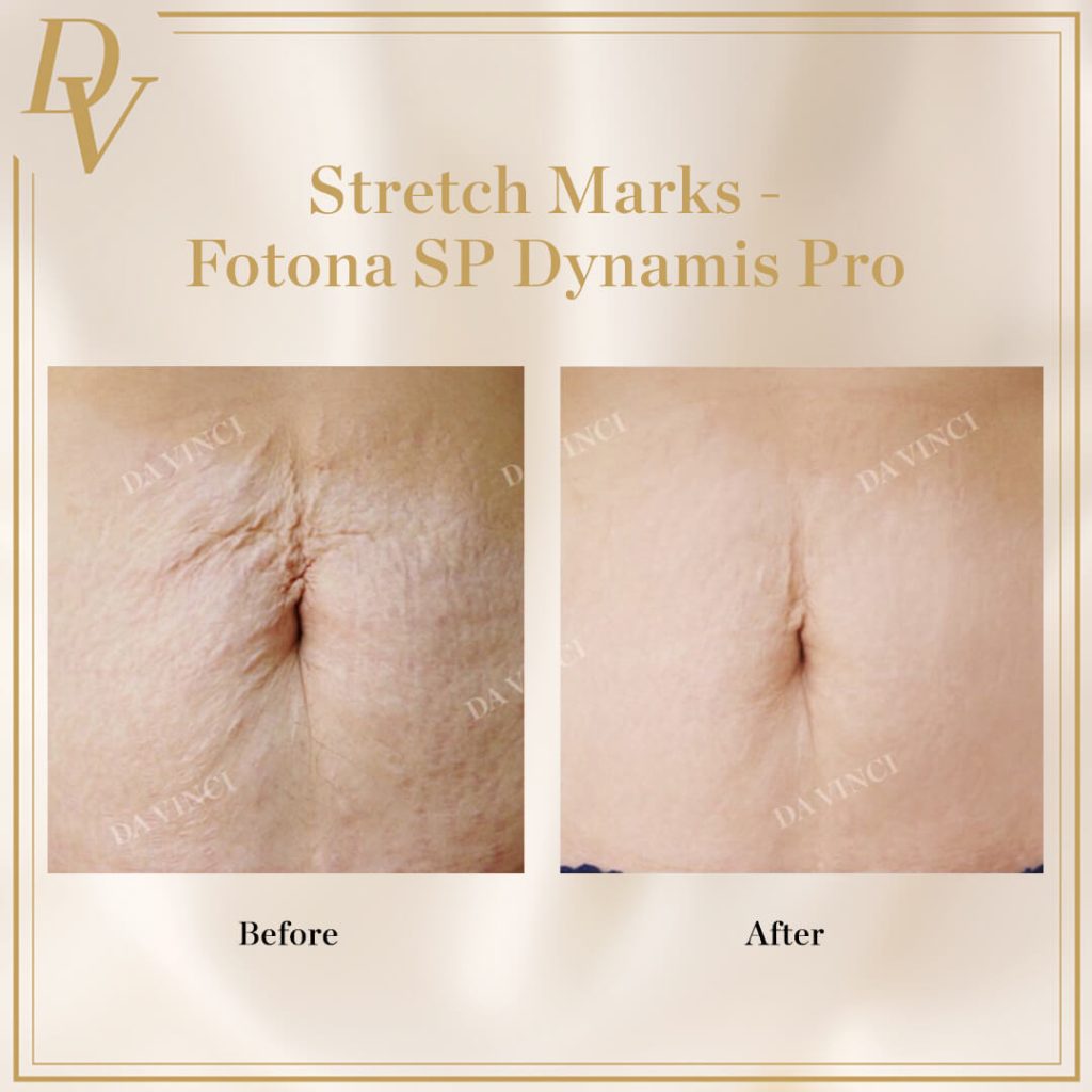 Stretch Marks I Da Vinci Clinic
