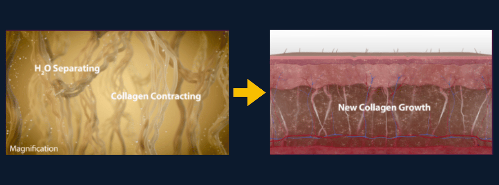 Thermage Treatment in KL at Da Vinci Clinic