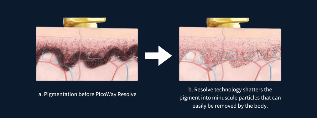 PicoWay Laser at Da Vinci Clinic – Effective Treatment for Dark Spots, Pigmentation, and Tattoo Removal.