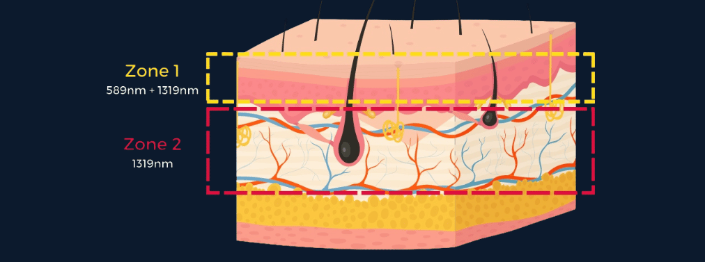 Areas targeted by ADVATX Yellow Laser