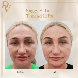 Aptos Thread Lift I Da Vinci Clinic