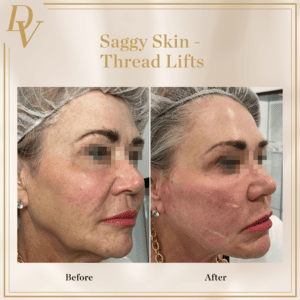 Aptos Thread Lift I Da Vinci Clinic