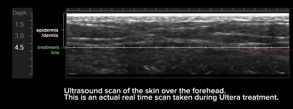 How does Ultherapy works