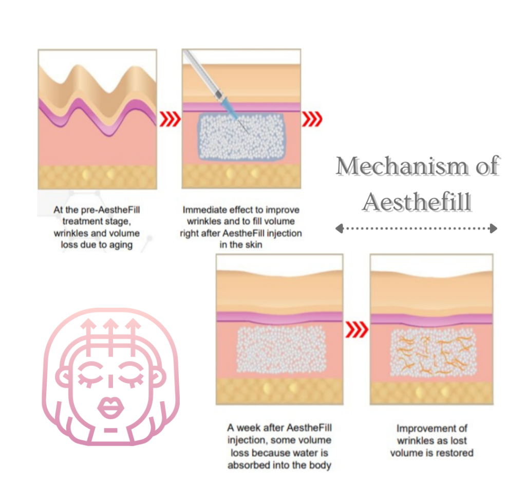 FDA-approved PDLLA collagen biostimulator technology mechanism of AestheFill for facial rejuvenation