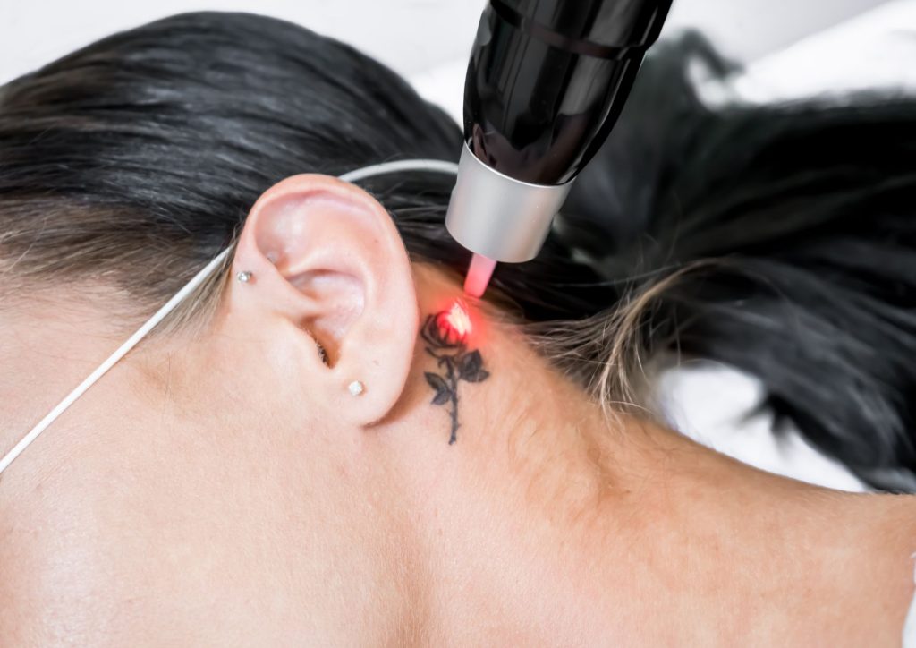Tattoo Removal