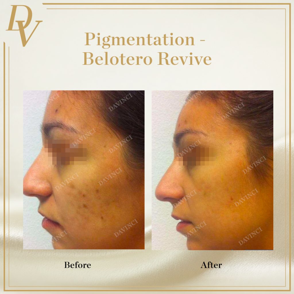 Belotero Revive