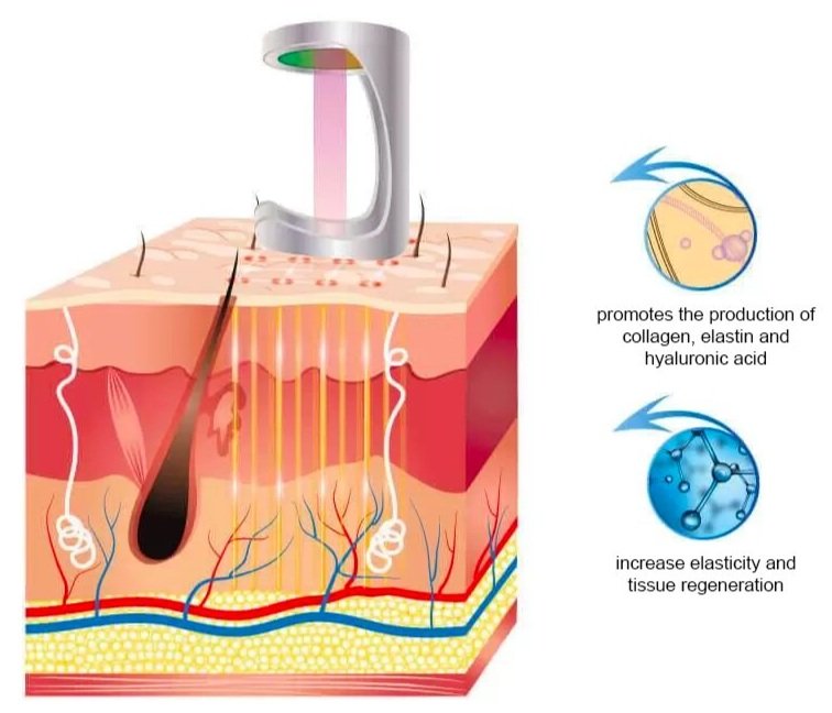 Fractional CO2 laser Treatment in KL