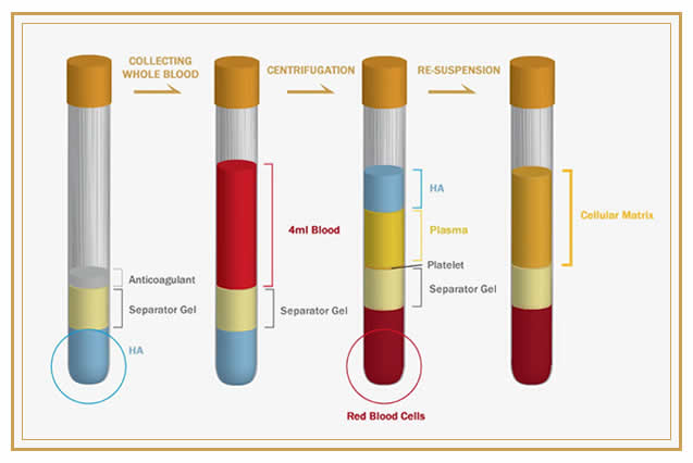 Platelet Rich Plasma PRP Treatment in KL