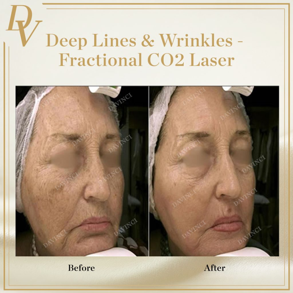 Fractional CO2 laser deep lines wrinkles