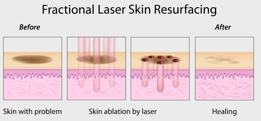 Fractional CO2 laser Treatment in KL