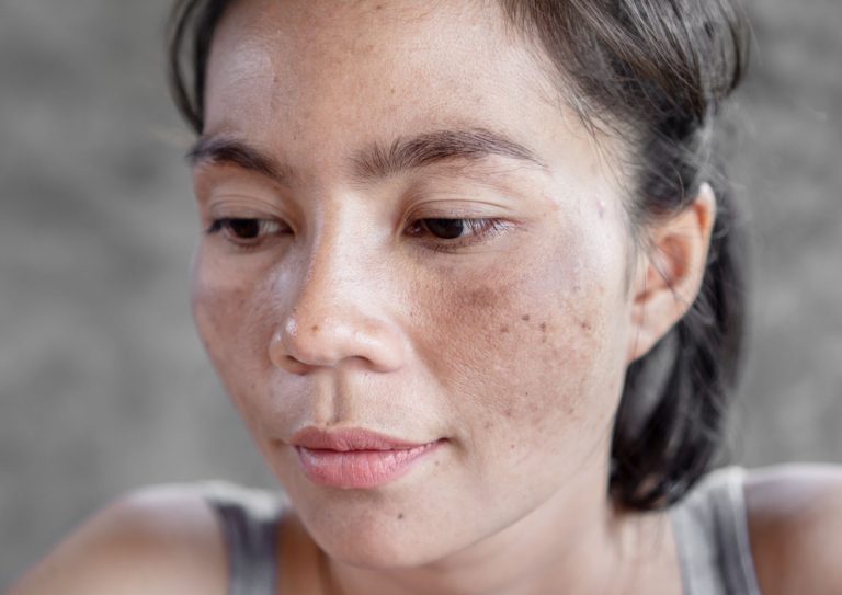Woman with melasma and pigmentation skin concerns before treatment at Da Vinci Clinic, Kuala Lumpur.