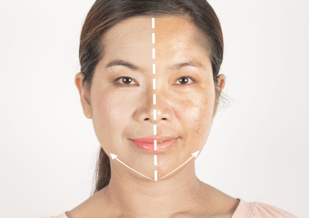 Melasma Skin, Pigmentation