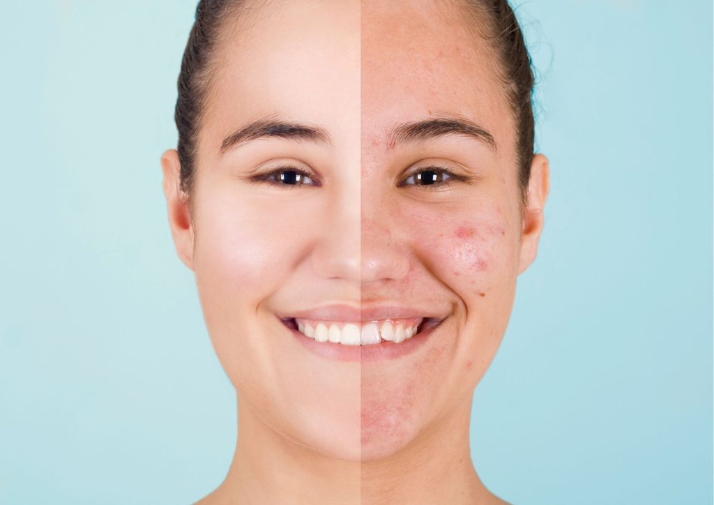 Acne Facial