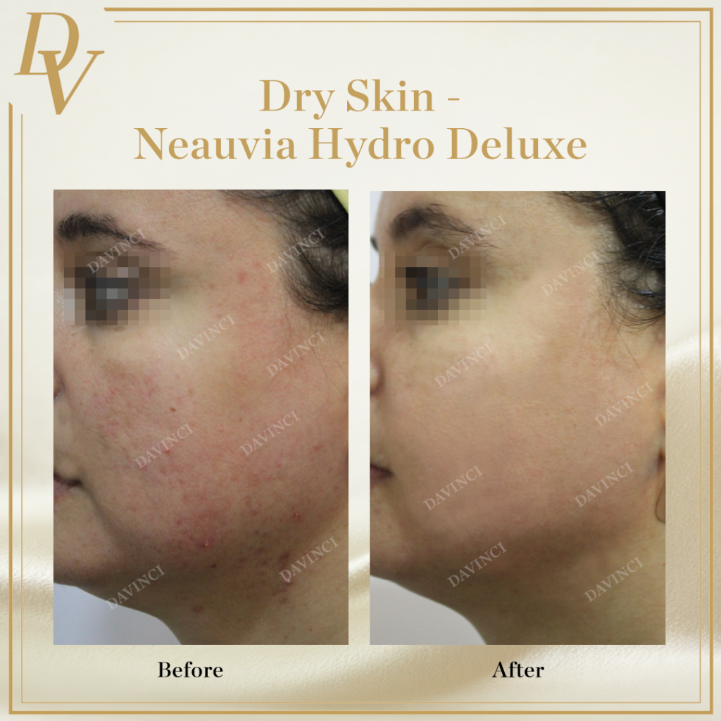 Neauvia Hydro Deluxe