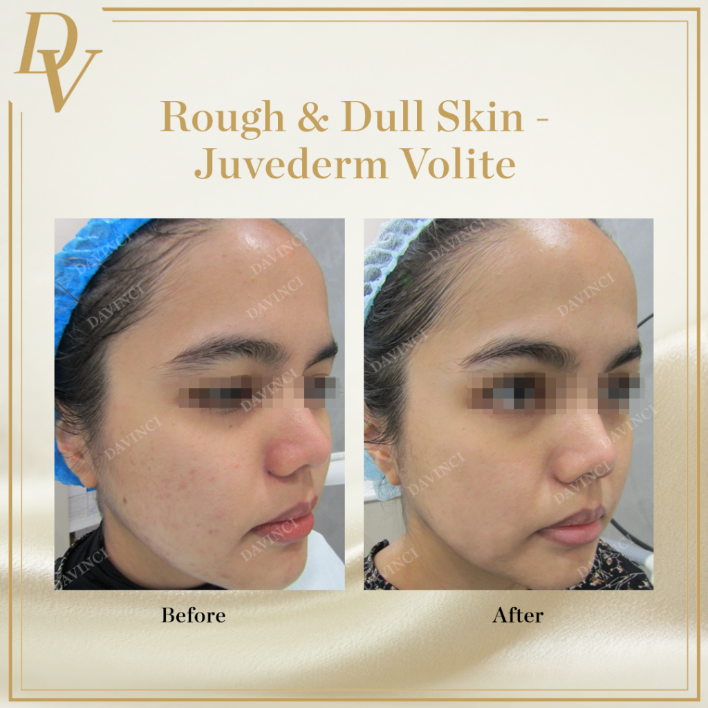 Juvederm Volite