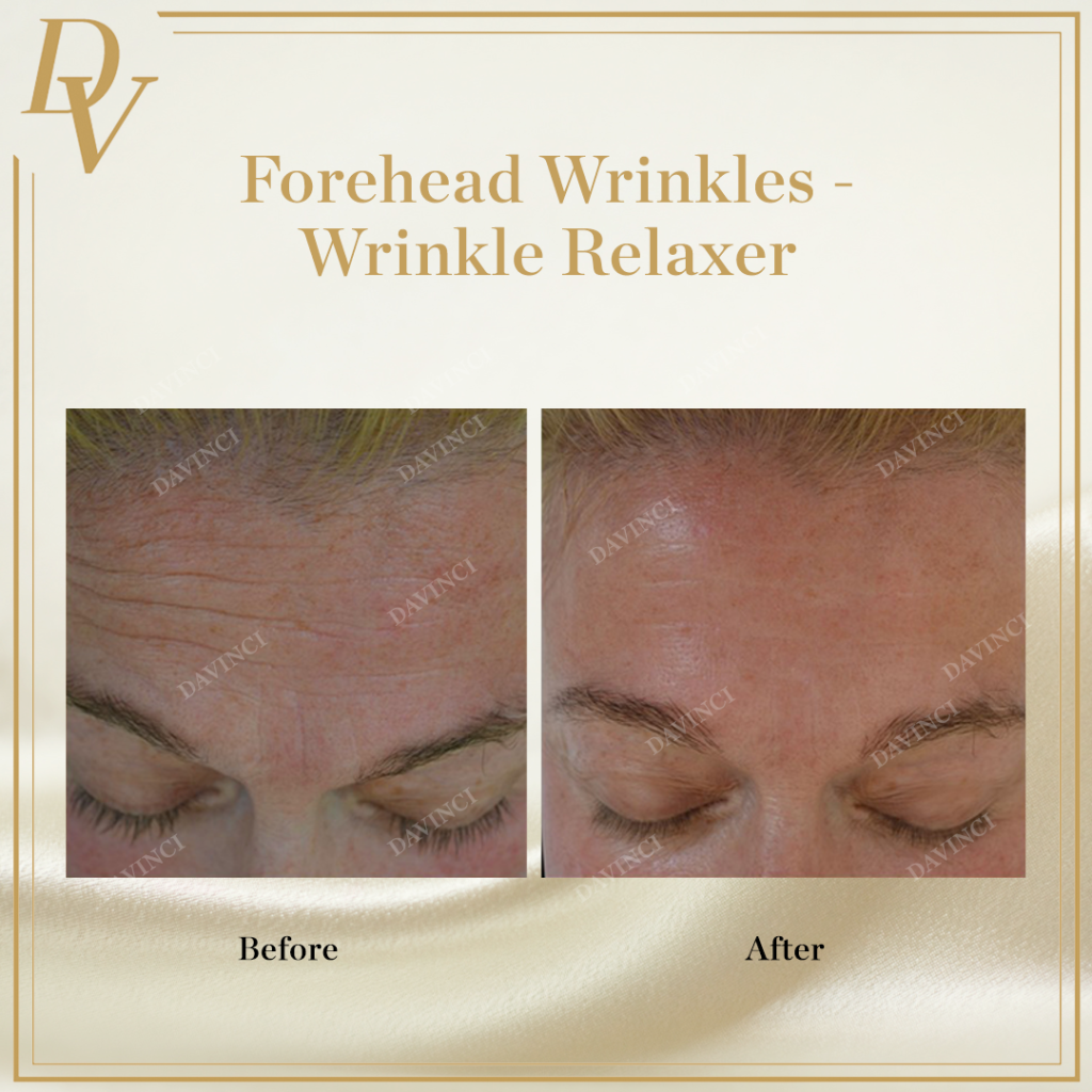 Forehead wrinkles, Wrinkle relaxer, botox, xeomin, nabota