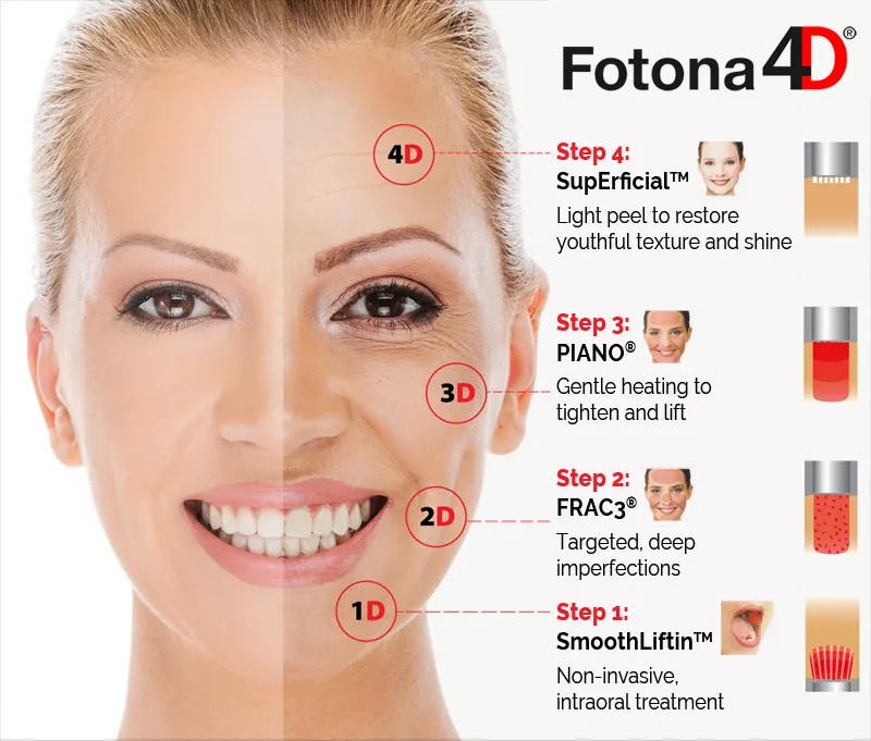Fotona 4D Treatment in KL