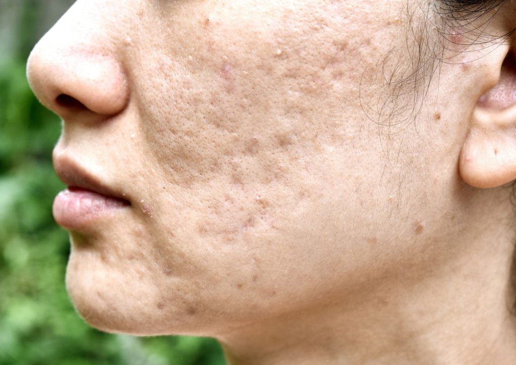 Types of Acne Scars