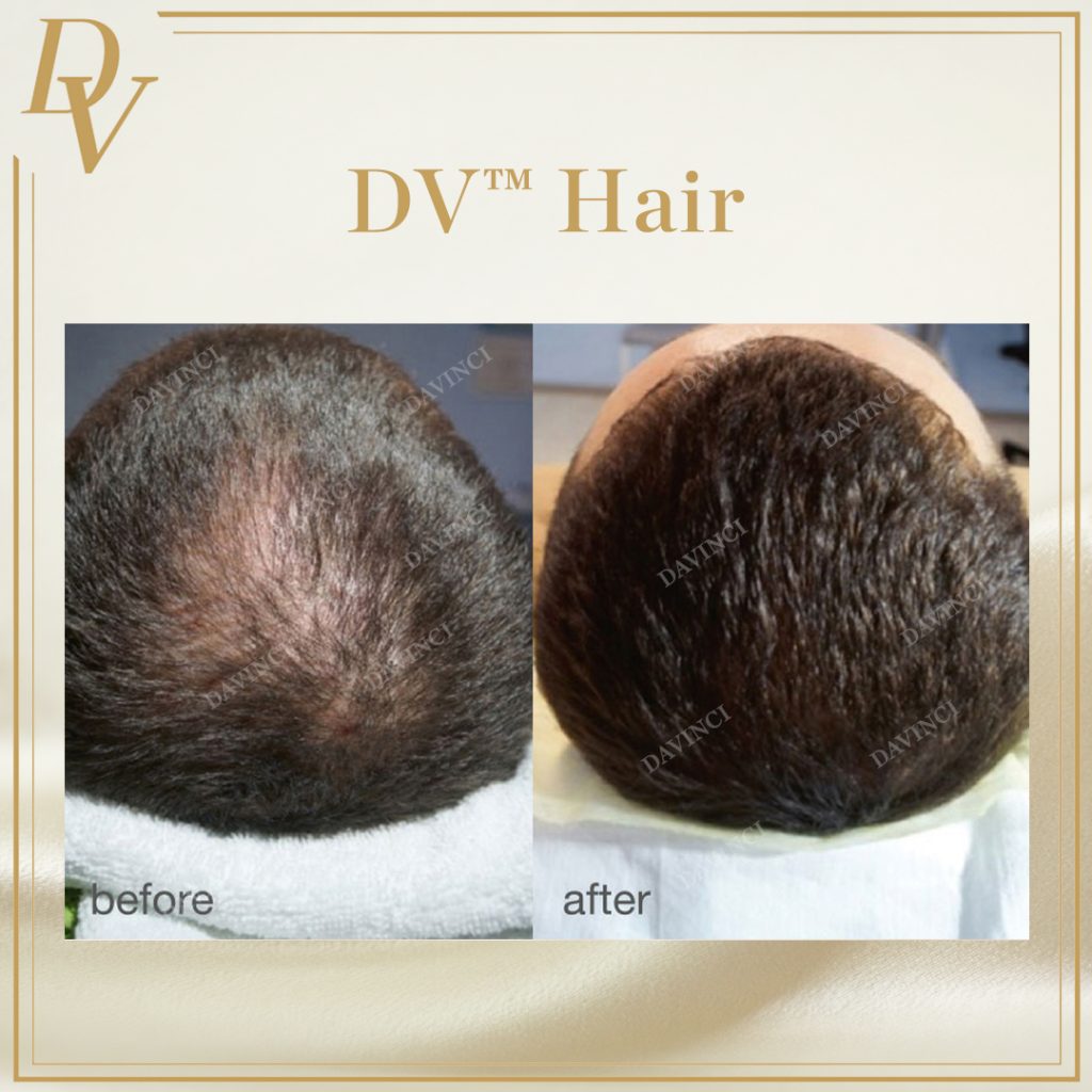 Da Vinci Clinic Hair Treatment in KL