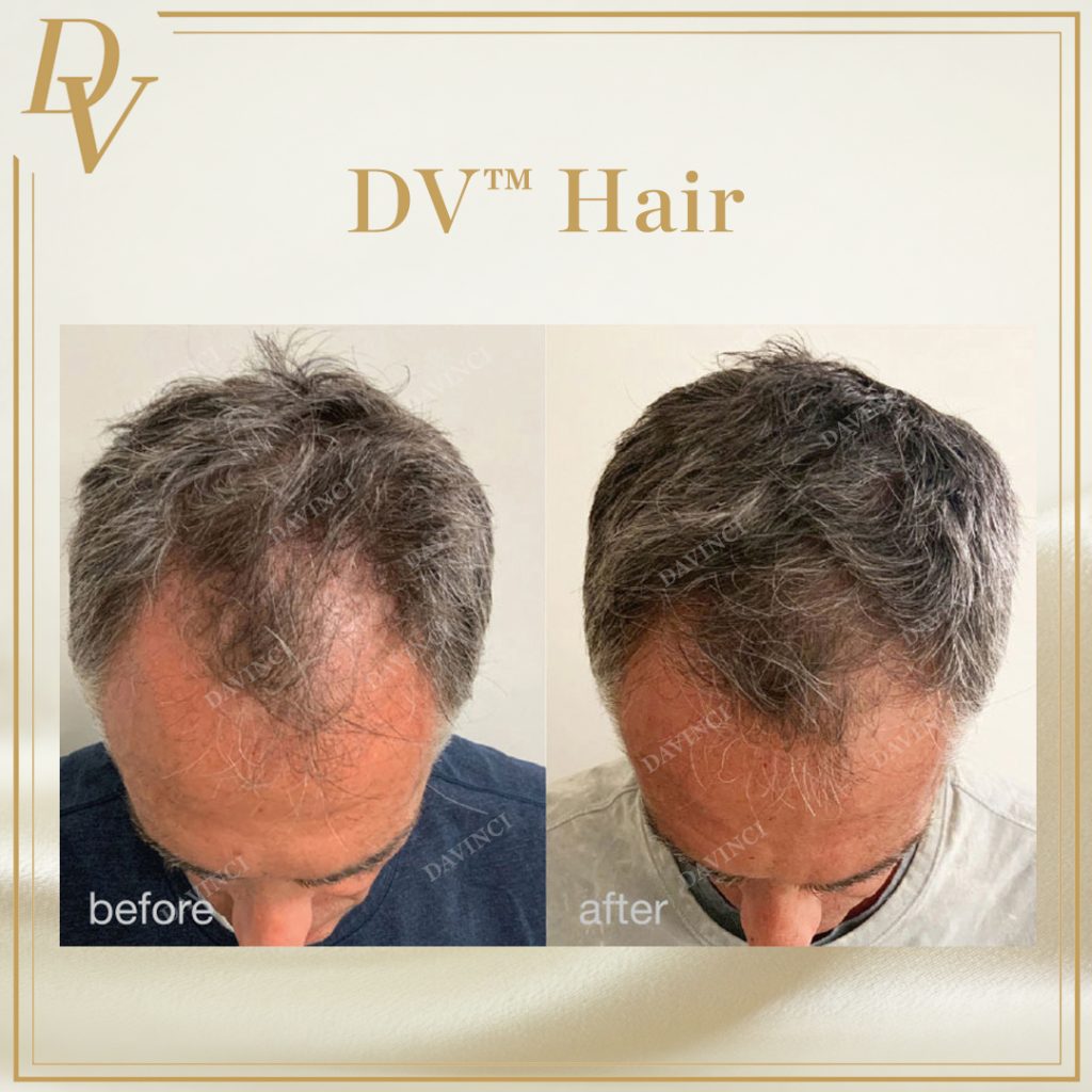 Da Vinci Clinic Hair Treatment in KL