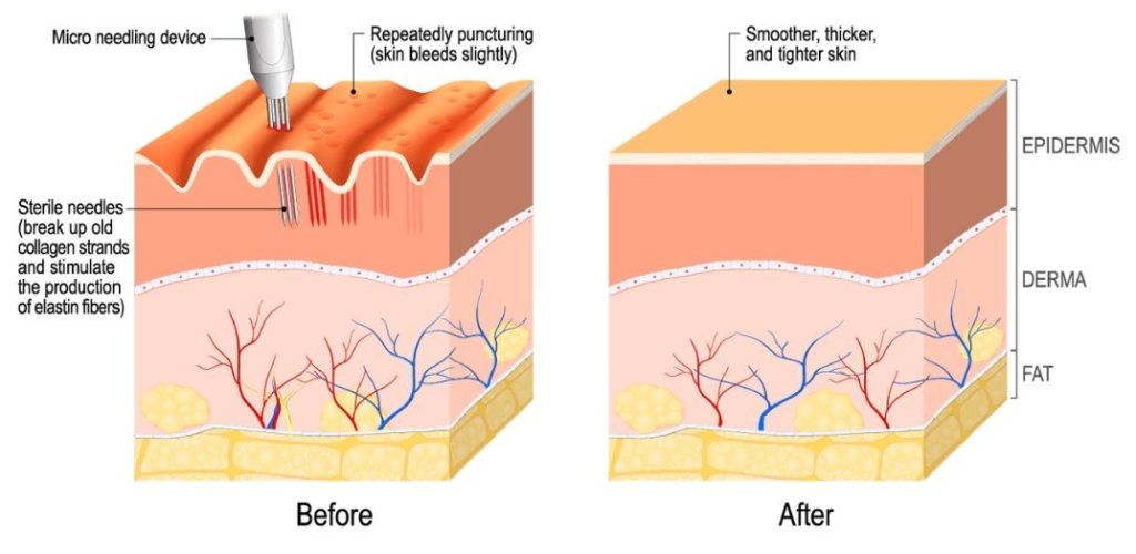 Microneedling, How it works