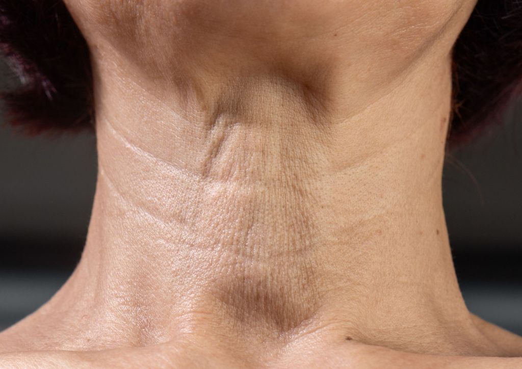 Neck Lines Treatment