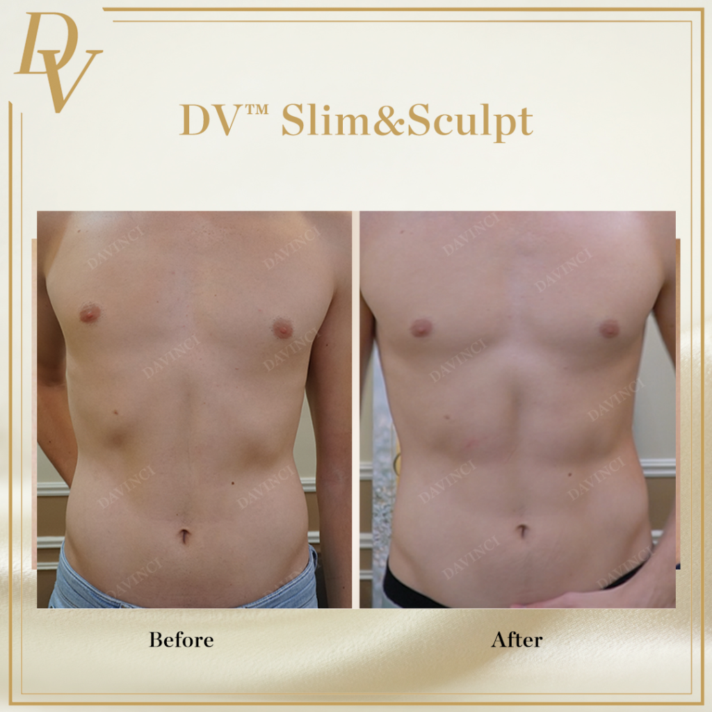 Before and after comparison of a client undergoing DV Slim & Sculpt treatment, showcasing visible fat reduction and body contouring improvements. Body Contouring at Da Vinci Clinic