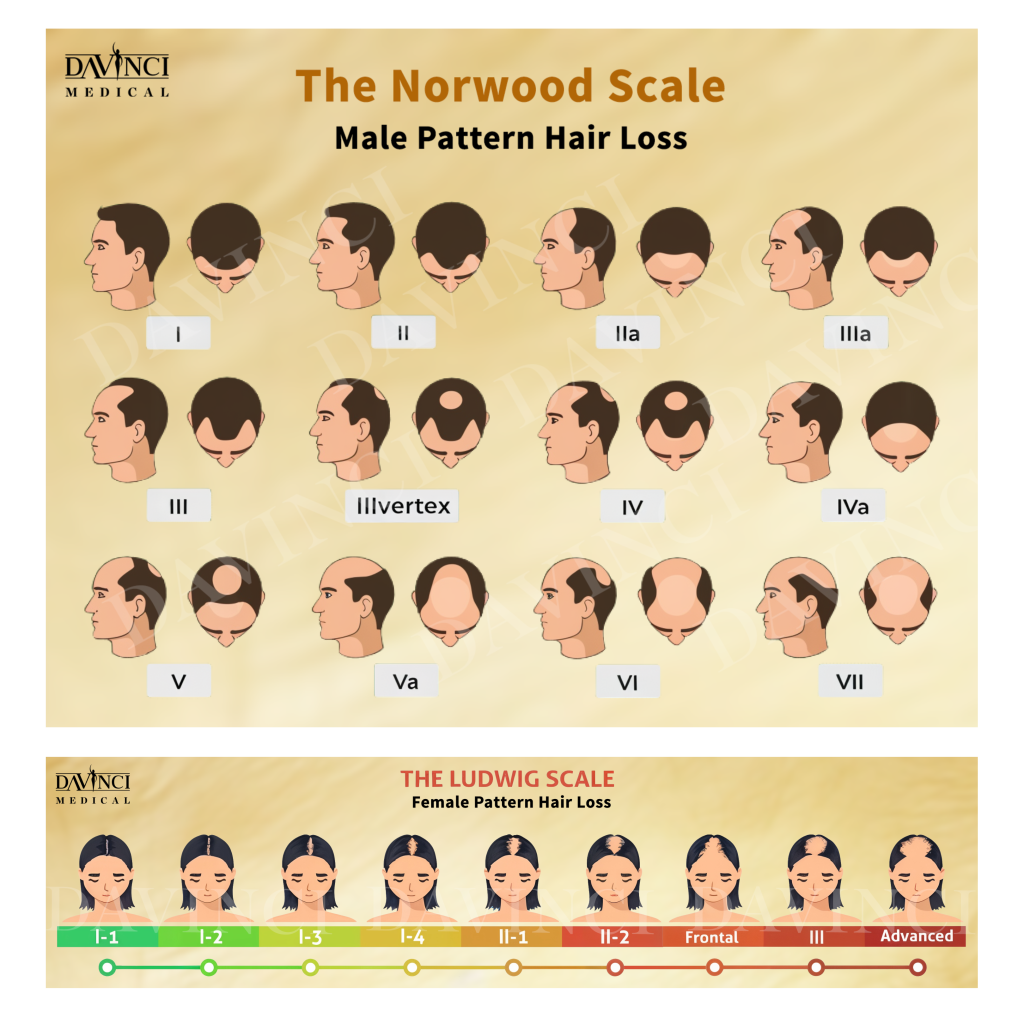 Hair Loss Stage for Men & Women at Da Vinci Clinic