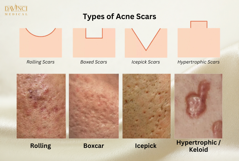 Type of Acne Scars